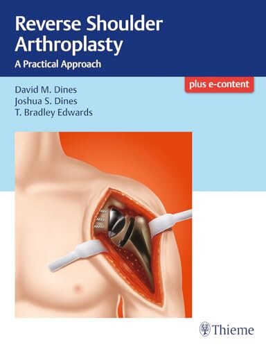 Reverse Shoulder Arthroplaty-Pratical Approach